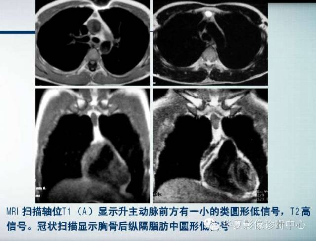 【PPT】纵隔囊肿性病变的影像学诊断
