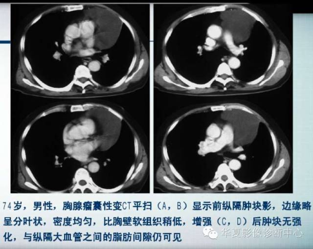 【PPT】纵隔囊肿性病变的影像学诊断