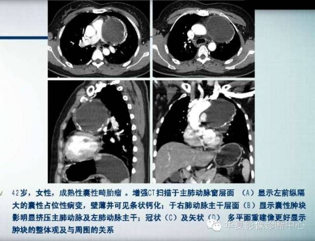 【PPT】纵隔囊肿性病变的影像学诊断