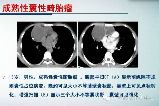 【PPT】纵隔囊肿性病变的影像学诊断