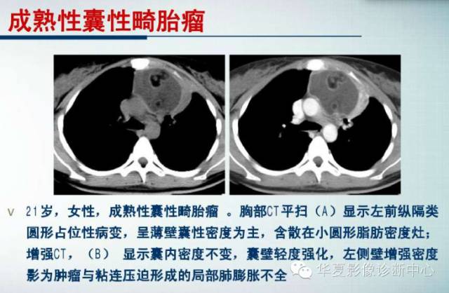 【PPT】纵隔囊肿性病变的影像学诊断