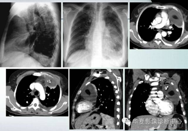 【PPT】纵隔囊肿性病变的影像学诊断