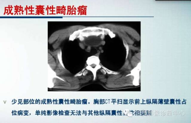 【PPT】纵隔囊肿性病变的影像学诊断