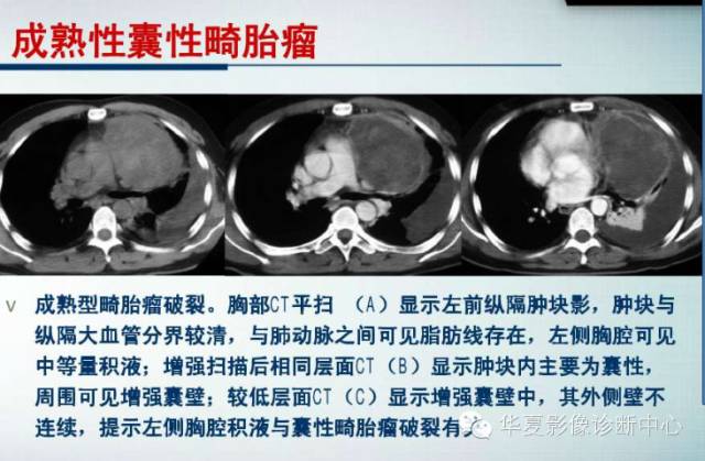 【PPT】纵隔囊肿性病变的影像学诊断