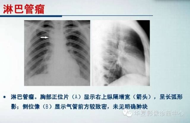 【PPT】纵隔囊肿性病变的影像学诊断