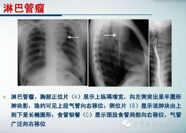 【PPT】纵隔囊肿性病变的影像学诊断