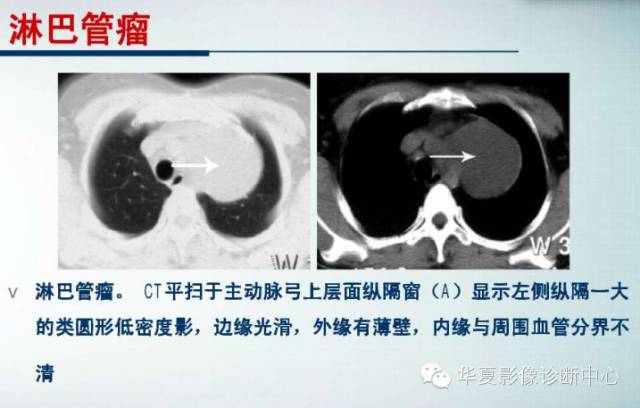 【PPT】纵隔囊肿性病变的影像学诊断