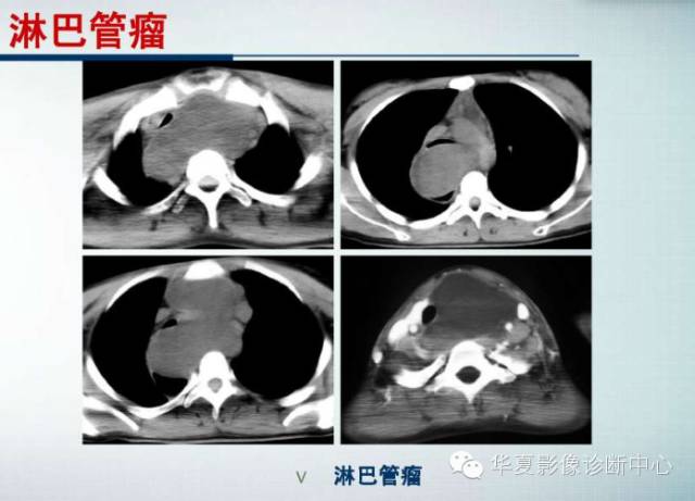 【PPT】纵隔囊肿性病变的影像学诊断
