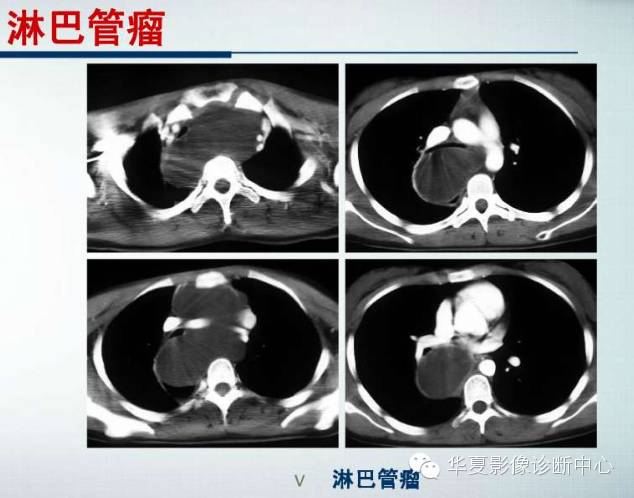 【PPT】纵隔囊肿性病变的影像学诊断