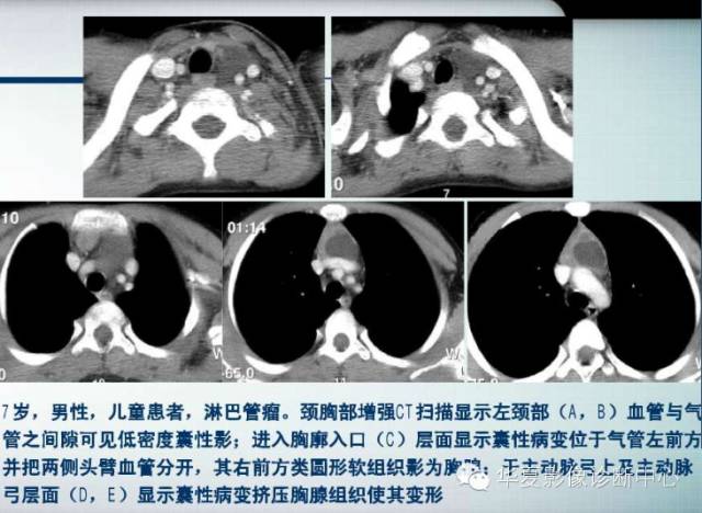 【PPT】纵隔囊肿性病变的影像学诊断