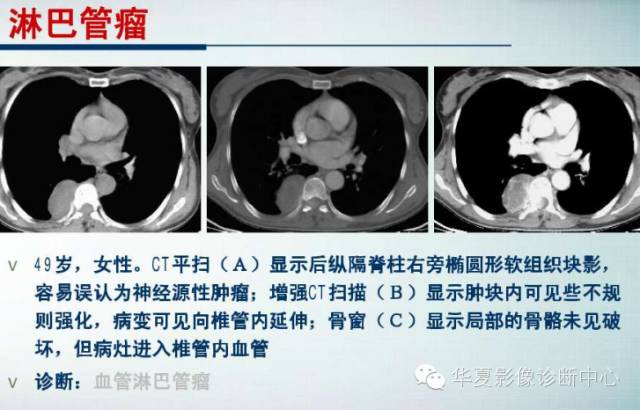 【PPT】纵隔囊肿性病变的影像学诊断