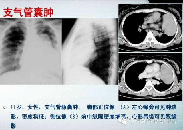 【PPT】纵隔囊肿性病变的影像学诊断