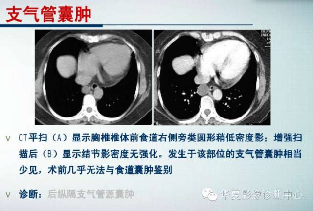 【PPT】纵隔囊肿性病变的影像学诊断