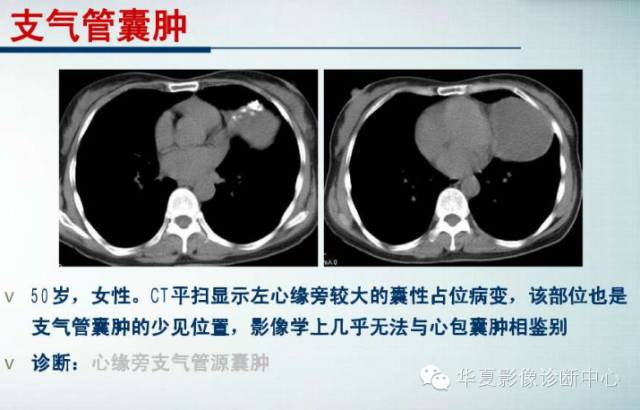 【PPT】纵隔囊肿性病变的影像学诊断