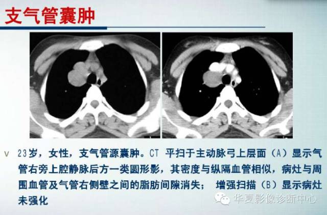 【PPT】纵隔囊肿性病变的影像学诊断