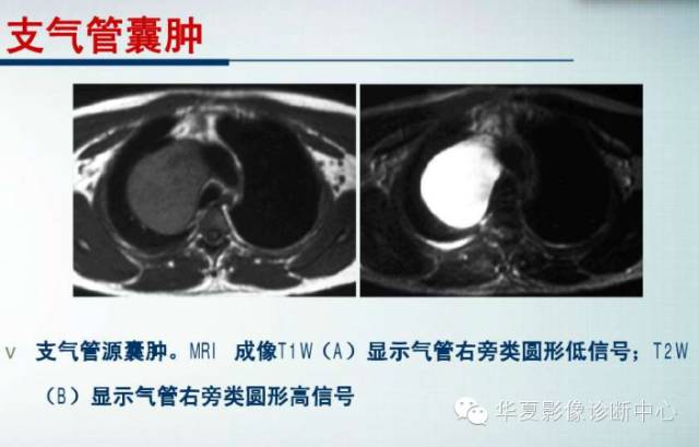 【PPT】纵隔囊肿性病变的影像学诊断