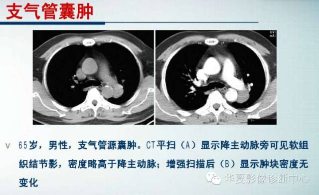 【PPT】纵隔囊肿性病变的影像学诊断
