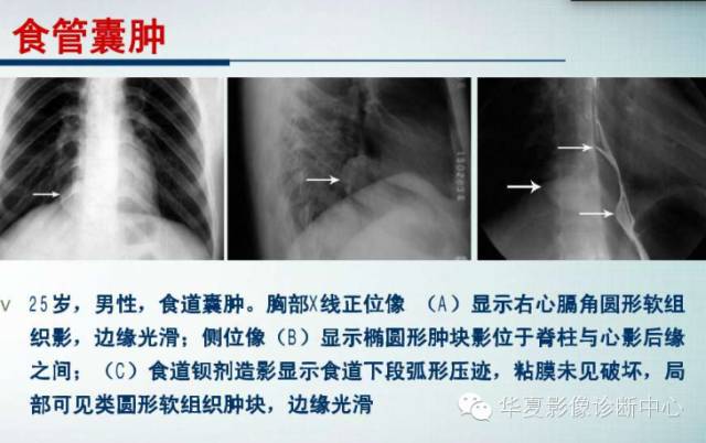 【PPT】纵隔囊肿性病变的影像学诊断