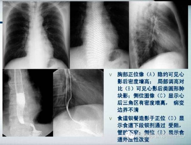 【PPT】纵隔囊肿性病变的影像学诊断