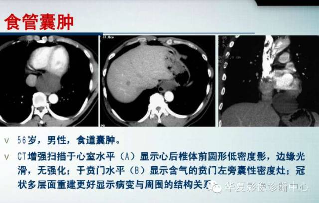 【PPT】纵隔囊肿性病变的影像学诊断