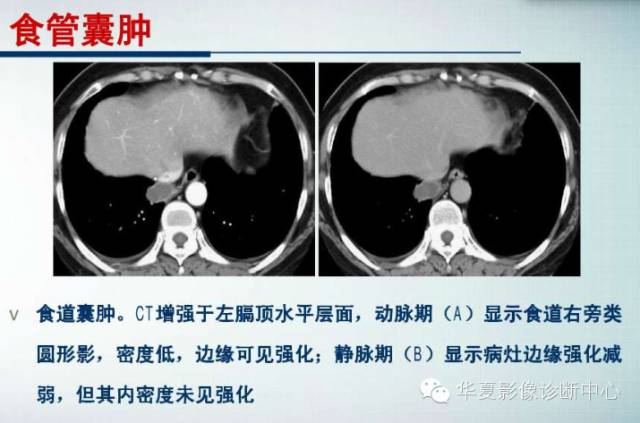 【PPT】纵隔囊肿性病变的影像学诊断