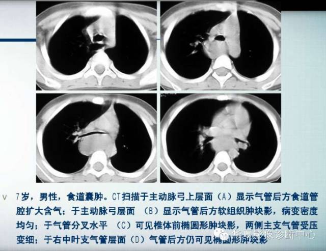 【PPT】纵隔囊肿性病变的影像学诊断