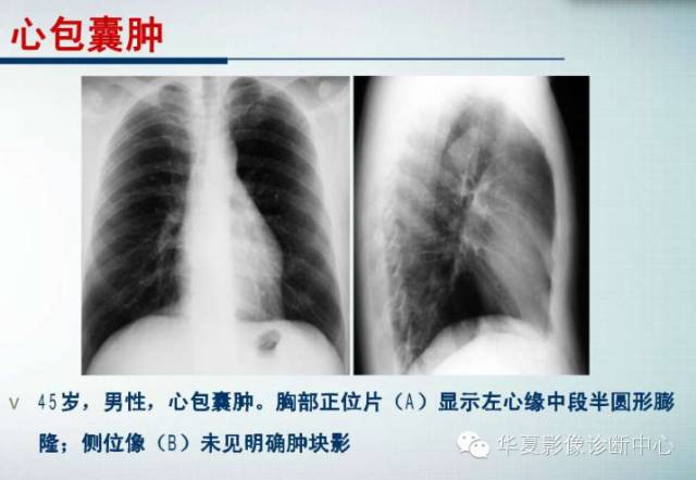 【PPT】纵隔囊肿性病变的影像学诊断