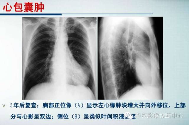 【PPT】纵隔囊肿性病变的影像学诊断