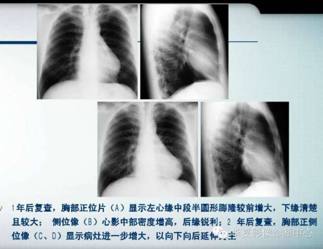 【PPT】纵隔囊肿性病变的影像学诊断