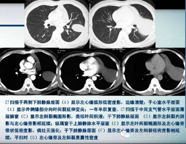 【PPT】纵隔囊肿性病变的影像学诊断
