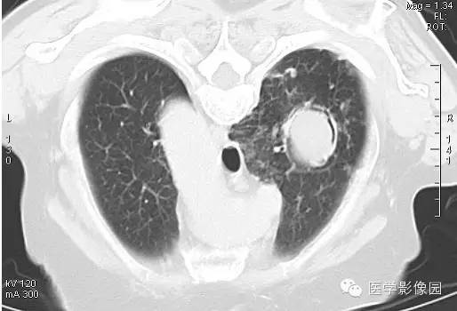 【病例】肺曲菌病1例CT影像表现