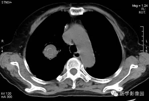 【病例】肺曲菌病1例CT影像表现