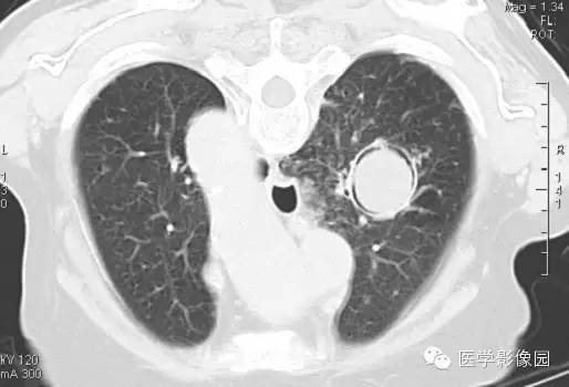 【病例】肺曲菌病1例CT影像表现