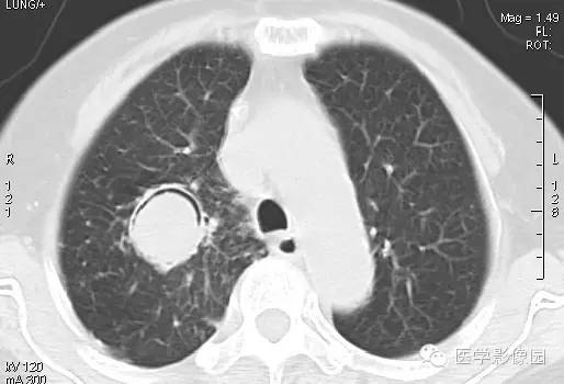 【病例】肺曲菌病1例CT影像表现