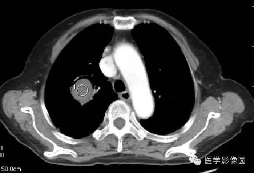 【病例】肺曲菌病1例CT影像表现