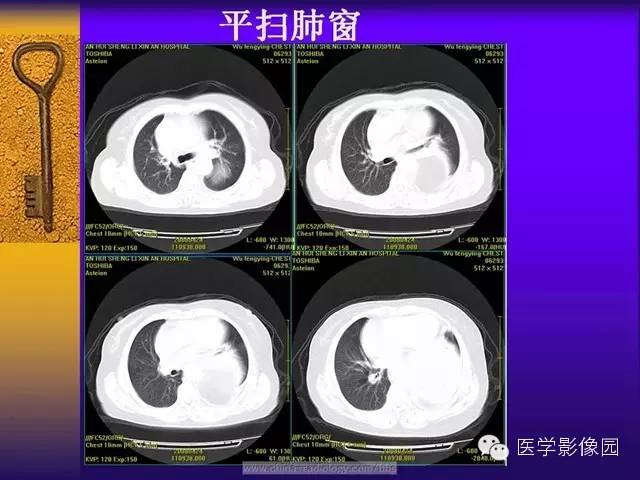 【病例】胸部孤立性纤维瘤1例CT影像表现