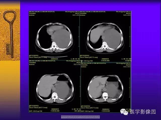 【病例】胸部孤立性纤维瘤1例CT影像表现