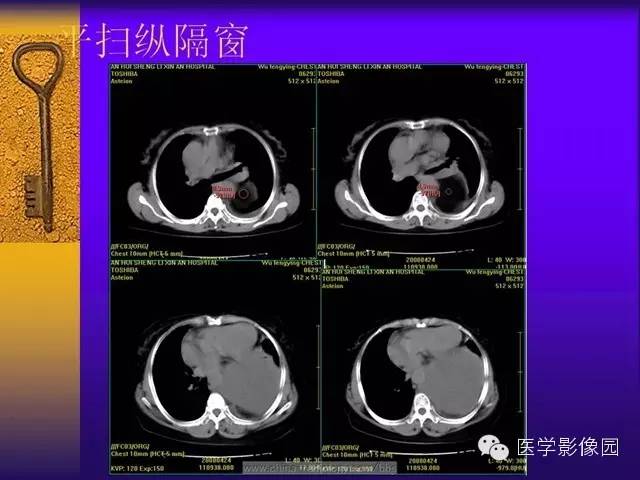 【病例】胸部孤立性纤维瘤1例CT影像表现