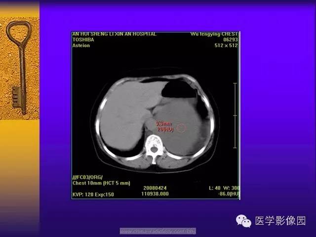 【病例】胸部孤立性纤维瘤1例CT影像表现