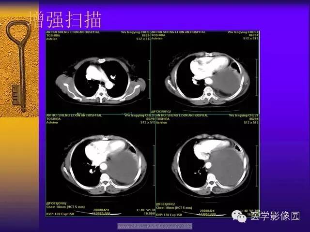 【病例】胸部孤立性纤维瘤1例CT影像表现
