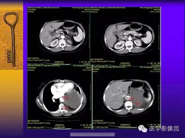 【病例】胸部孤立性纤维瘤1例CT影像表现