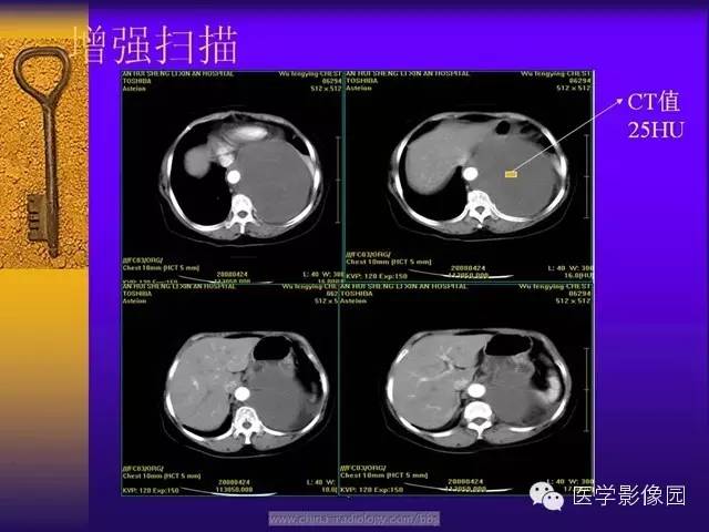 【病例】胸部孤立性纤维瘤1例CT影像表现