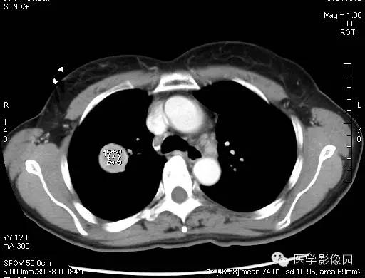 【病例】硬化性血管瘤1例CT影像表现
