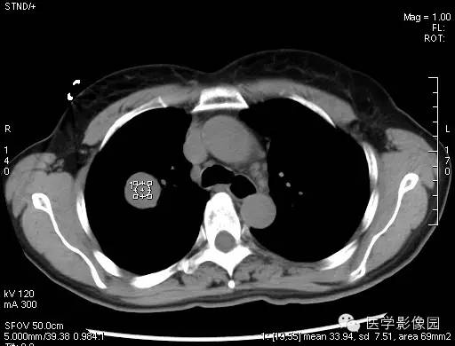 【病例】硬化性血管瘤1例CT影像表现