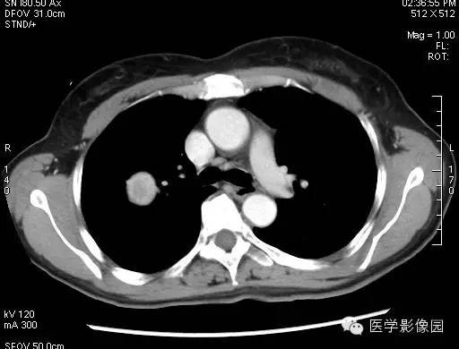 【病例】硬化性血管瘤1例CT影像表现