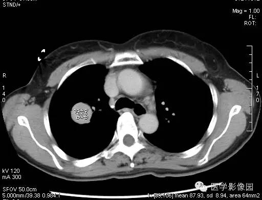 【病例】硬化性血管瘤1例CT影像表现