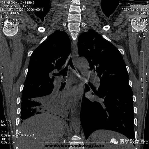 【病例】支气管异物1例CT影像表现