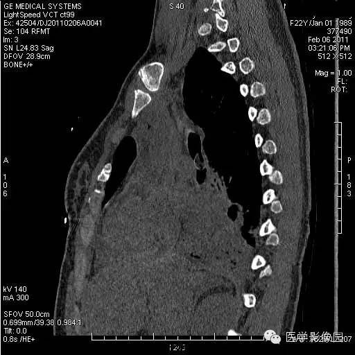【病例】支气管异物1例CT影像表现