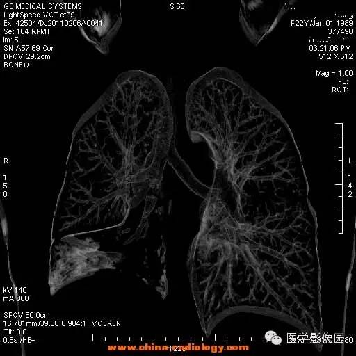 【病例】支气管异物1例CT影像表现