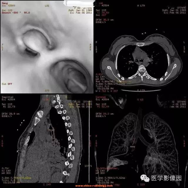 【病例】支气管异物1例CT影像表现